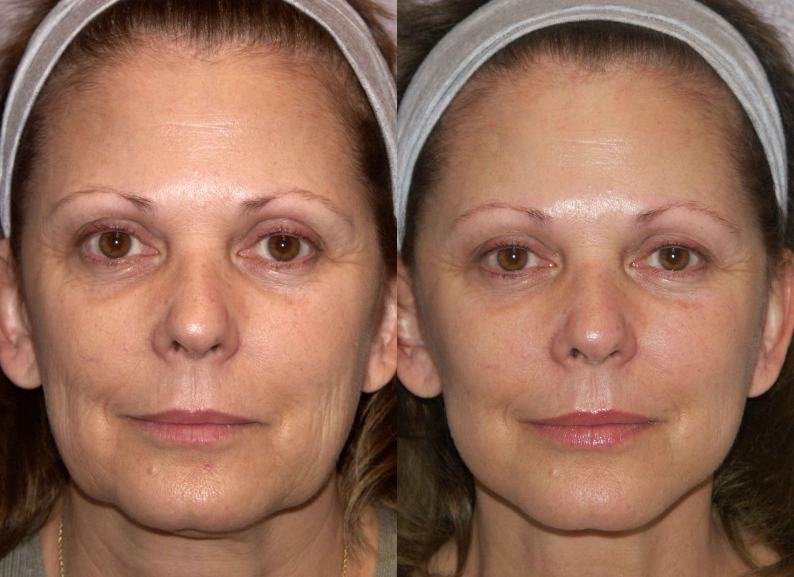 botox-for-your-lower-face-and-neck